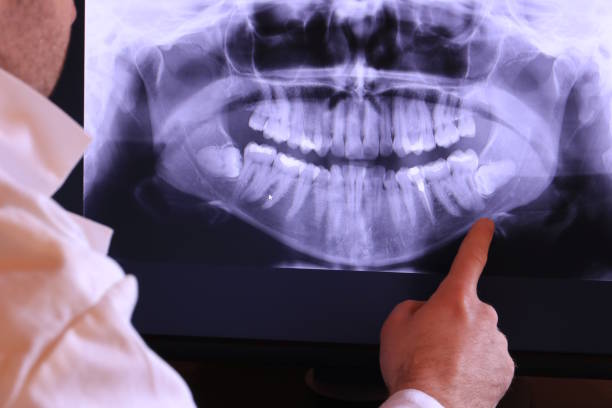 Best Emergency Dentist for Lost Fillings or Crowns in Dublin, CA